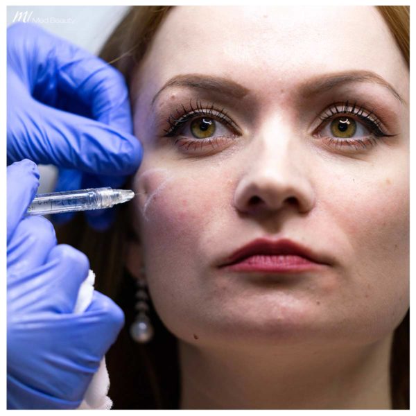 cheek filler treatment at M1 Med Beauty- injection