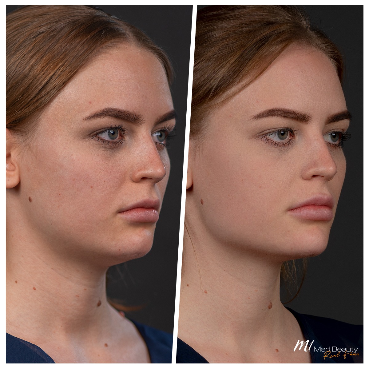 Anti-wrinkle-treatment-before-after-4