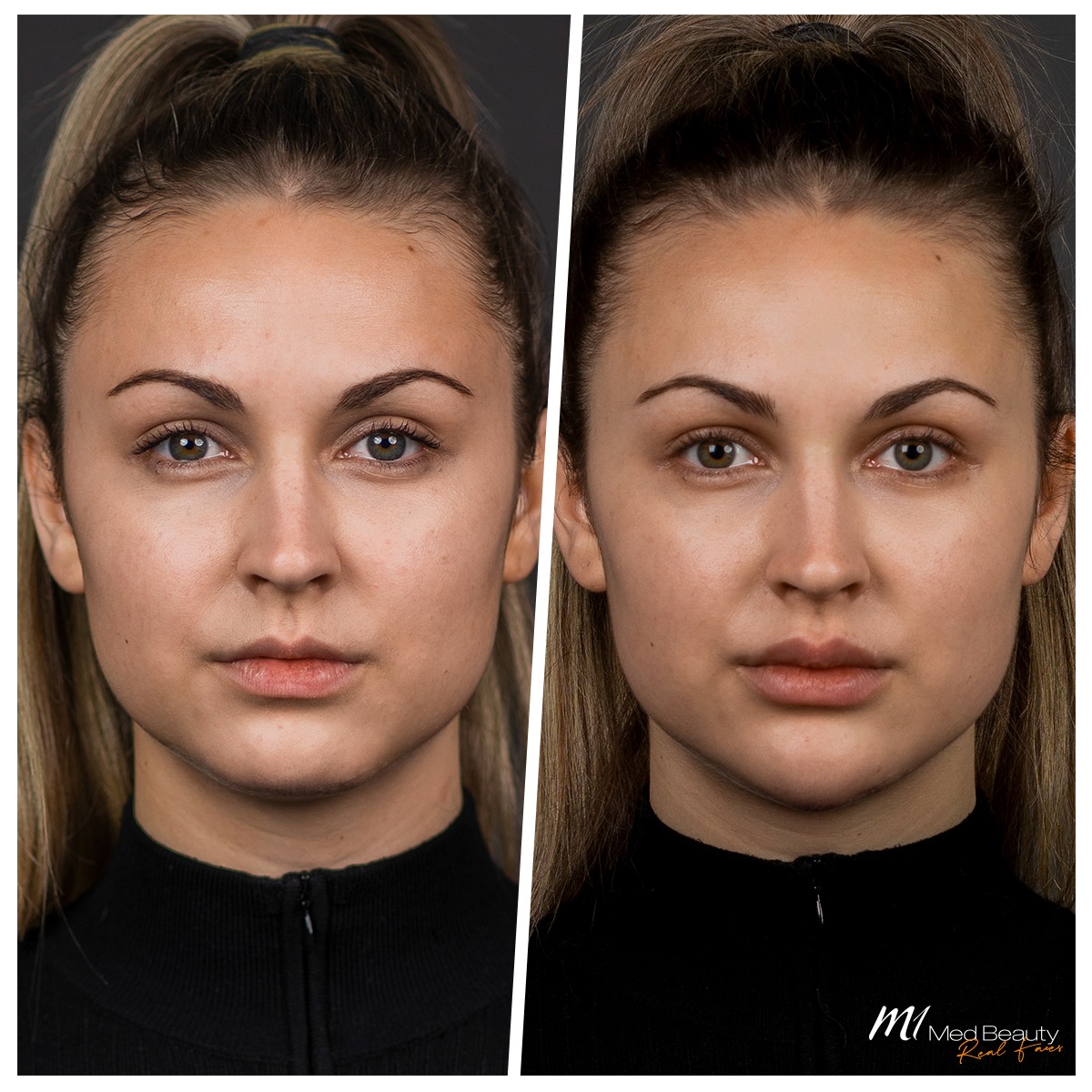 Anti-wrinkle-treatment-before-after-4