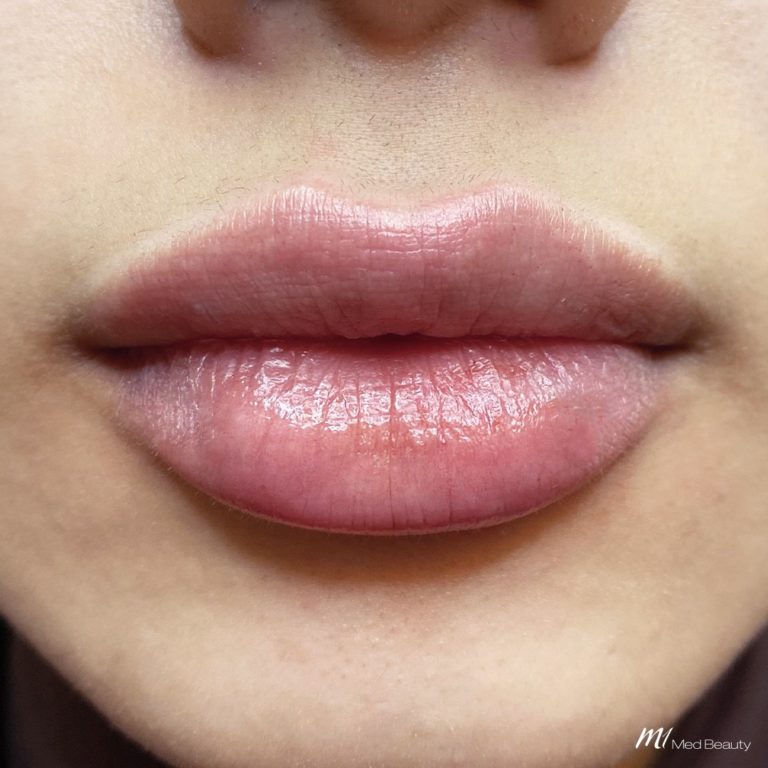 lip filler before after 12