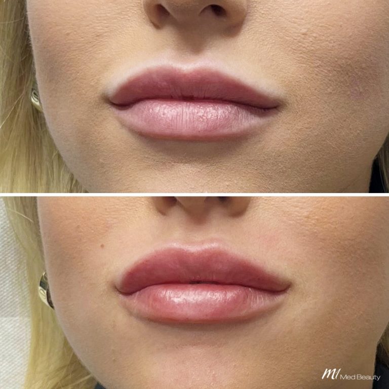 lip filler before after 8
