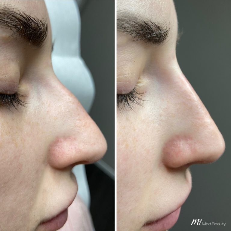 nose dermal filler before after 7